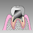かぶせ物の装着
